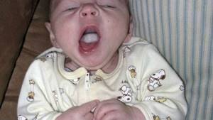 молочница у младенцев во рту лечение симптомы и лечение