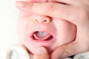 молочница у новорожденного симптомы и лечение