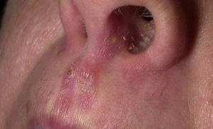 молочница в носу у взрослых симптомы лечение