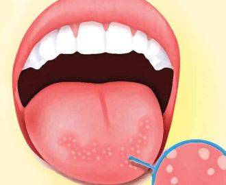 молочница во рту на языке у взрослых симптомы лечение