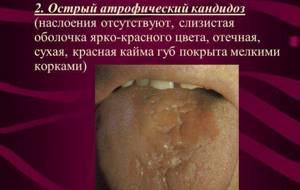 молочница во рту у взрослых симптомы лечение содой