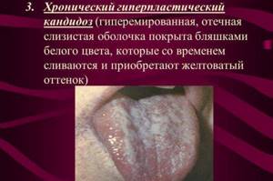 молочница во рту у взрослых симптомы лечение содой
