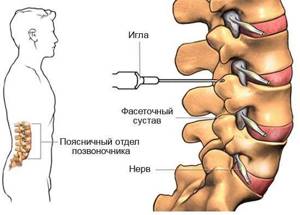 обострение шейно грудного остеохондроза симптомы лечение
