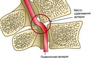 остеохондроз шейно грудного отдела симптомы лечение