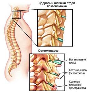 остеохондроз шейного отдела симптомы и лечение медикаментозное