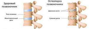 остеопороз симптомы и лечение шейного отдела
