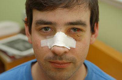 перелом носа симптомы лечение последствия травмы