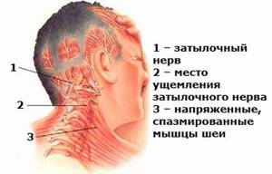 шейный остеохондроз симптомы лечение головная боль