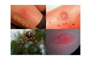укус паука симптомы и лечение