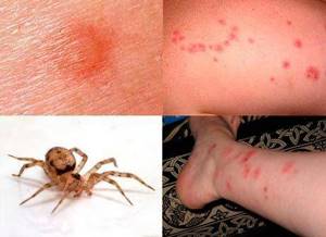 укус паука симптомы и лечение