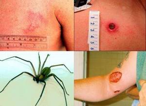 укус паука симптомы лечение