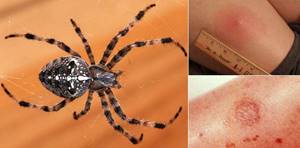 укус паука симптомы у человека лечение народными средствами