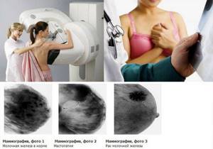 узловая мастопатия молочной железы симптомы и лечение
