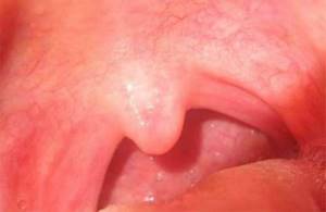 воспаление горла симптомы и лечение