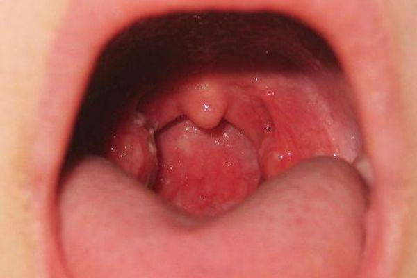 воспаление горла симптомы лечение