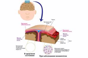 воспаление мозга симптомы и лечение