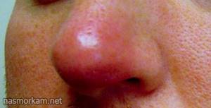 воспаление носовой перегородки симптомы лечение
