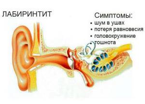 воспаление внутреннего уха симптомы лечение