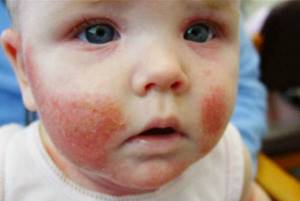 аллергия у ребенка симптомы лечение