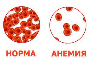 анемия у ребенка симптомы лечение