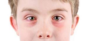 блефарит симптомы и лечение у ребенка