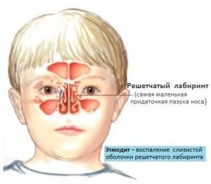 этмоидит симптомы и лечение у ребенка