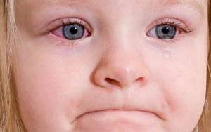 кератит у ребенка симптомы и лечение