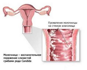 молочница симптомы и лечение у девушек