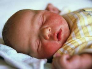 молочница у ребенка симптомы лечение