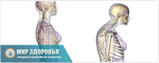 остеопороз шеи симптомы и лечение