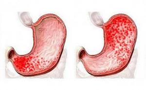 воспаление слизистой желудка симптомы и лечение