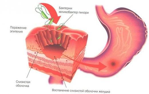 воспаление слизистой желудка симптомы и лечение