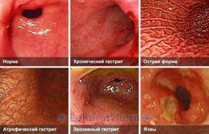 воспаление слизистой желудка симптомы и лечение