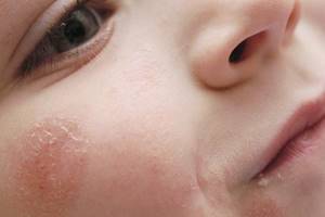 аллергический контактный дерматит у ребенка симптомы и лечение