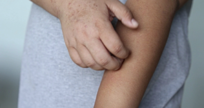 аллергия на диаскинтест у ребенка симптомы и лечение
