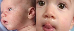 аллергия на грушу у ребенка симптомы и лечение