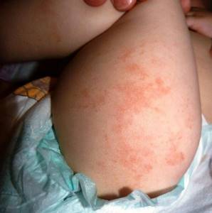 аллергия на грушу у ребенка симптомы и лечение