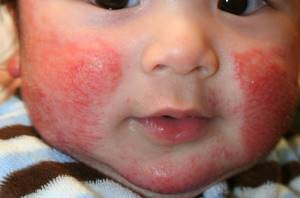 аллергия на конфеты у ребенка симптомы и лечение