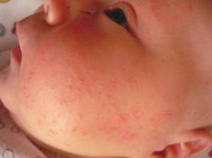 аллергия на орехи у ребенка симптомы и лечение
