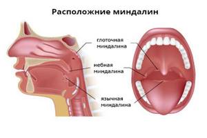ангина у грудного ребенка симптомы и лечение