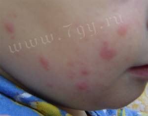 атопический аллергический дерматит у ребенка симптомы и лечение
