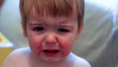 дерматит у ребенка симптомы и лечение народными средствами