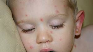 энтеровирусная инфекция у ребенка симптомы и лечение