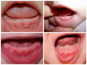 если у ребенка прорезываются зубы симптомы и лечение