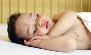 герпес на теле у ребенка симптомы лечение