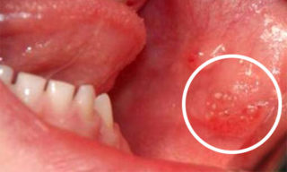 герпес у ребенка во рту симптомы лечение