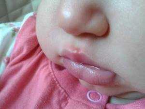 герпетический вирус у ребенка симптомы и лечение