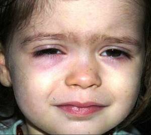 глисты у ребенка 6 месяцев симптомы и лечение