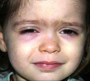 глисты у ребенка 8 месяцев симптомы и лечение