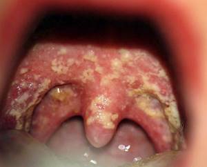 грибок горла у ребенка симптомы лечение